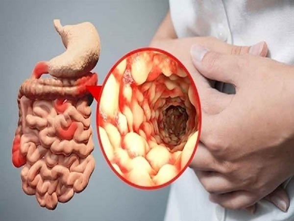 Những người phụ nữ bị mắc bệnh Crohn có kèm đường rò âm đạo, khả năng biến chứng cao